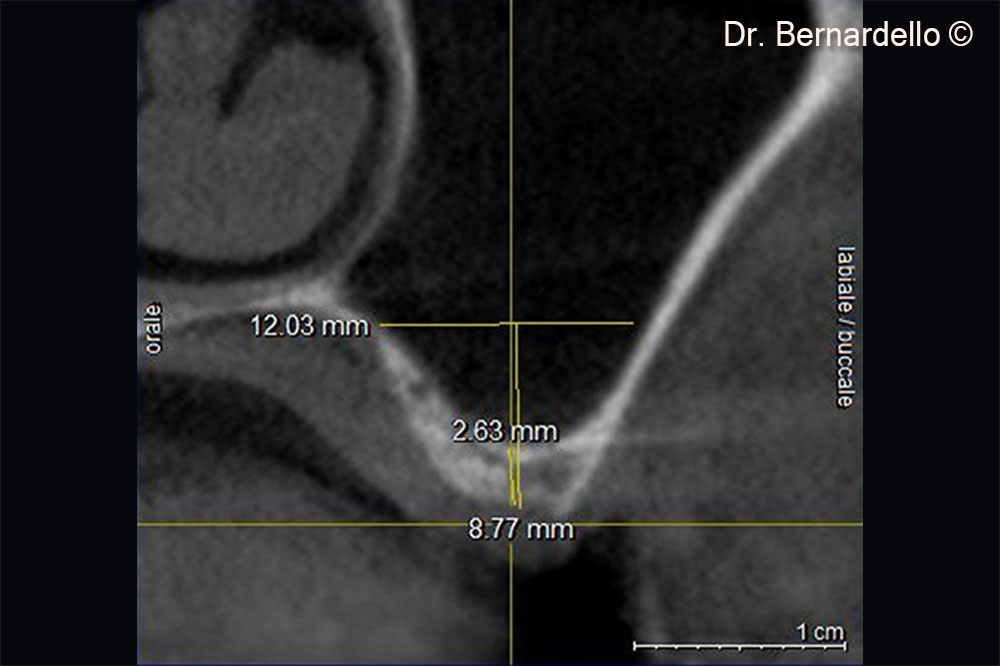 Based on the sinus width, the patient is considered eligible for a transcrestal sinus floor elevation