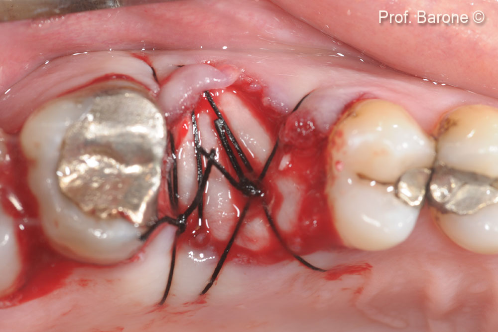 Fresh extraction socket grafted with MP3 and Evolution membrane