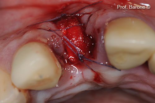 Fresh Extraction socket treated with collagen sponge and cross-suture