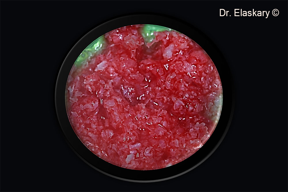 Gen-Os® is mixed with autogenous bone chips 50-50