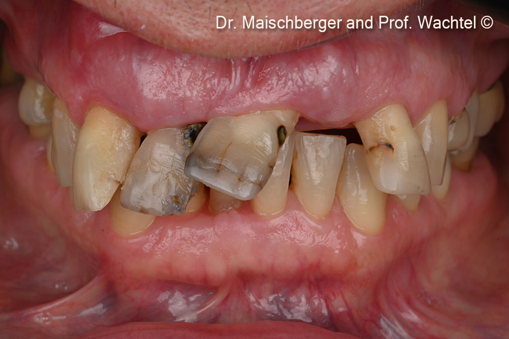 Intraoral frontal view – initial situation.