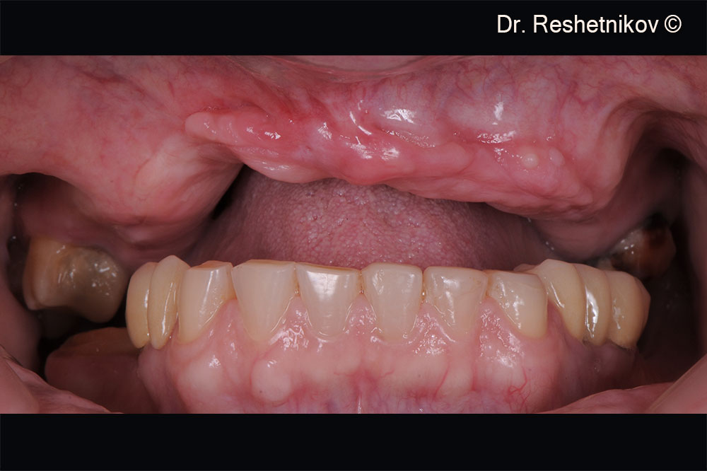 Intraoral view. Severe destruction of the alveolar ridge of the upper jaw and soft tissue deficiency