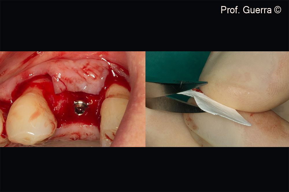 Left) two-stage implant surgery; Right) membrane trimming