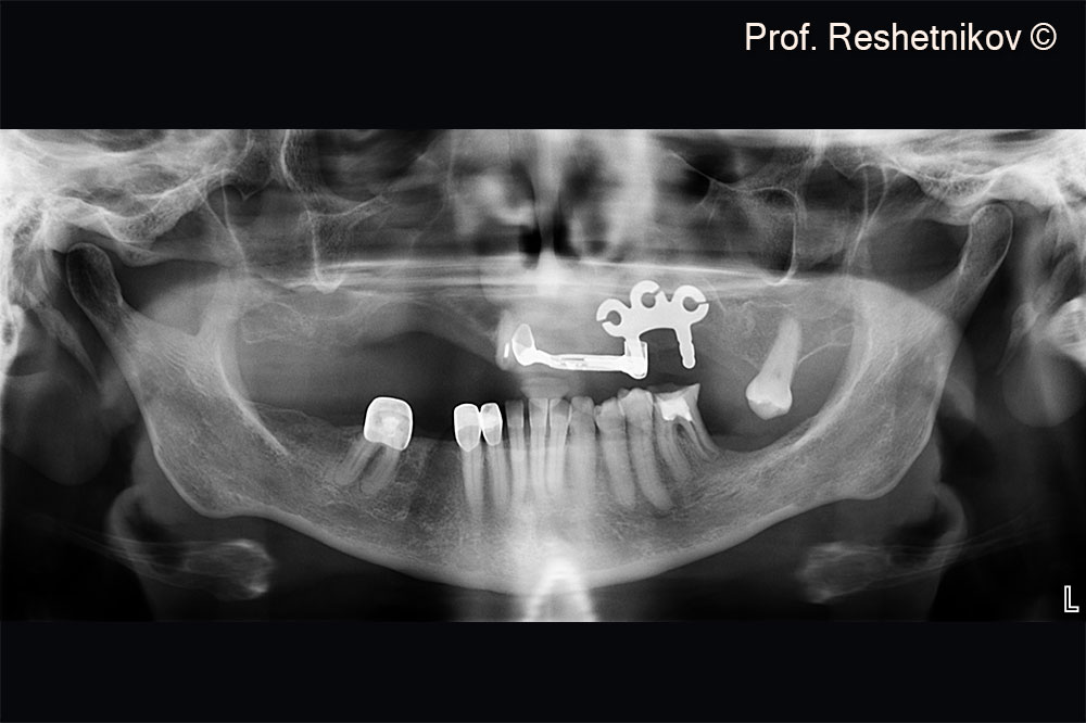 Panoramic radiograph of the pronounced atrophy of the alveolar ridge of the upper jaw due to the inflammatory process caused by a previously installed plate implant