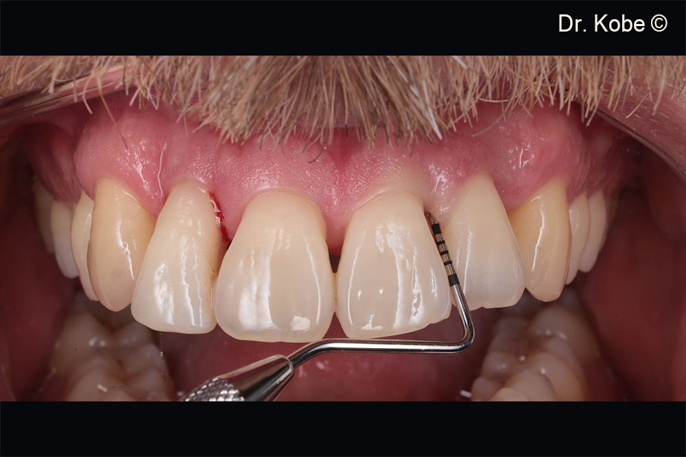 Initial situation in the second quadrant