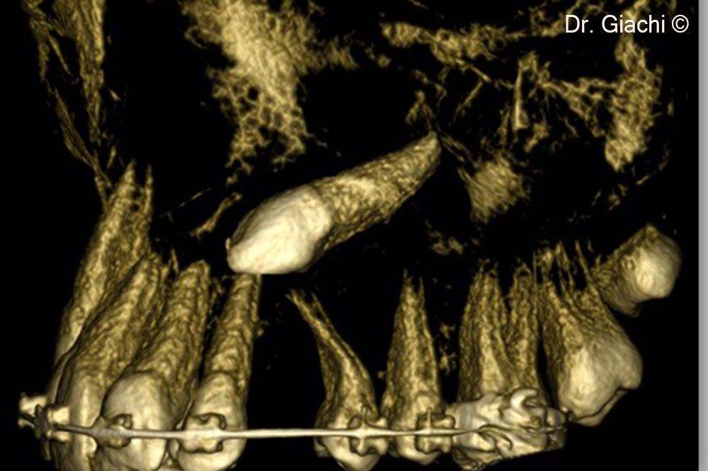 CBCT rendering showing canine position