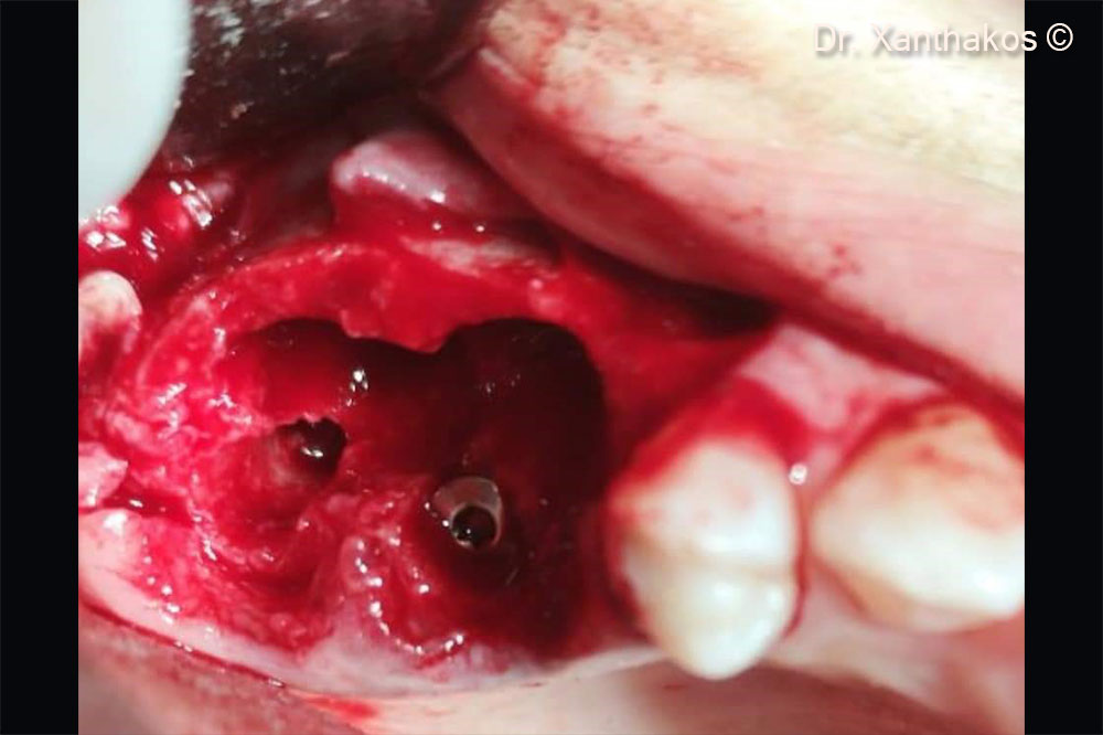 The two implants  were placed almost 2 or 3mm deeper to the residual palatal bony wall