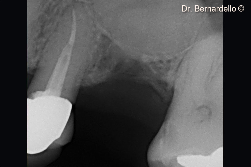 Gel 40 is used to detach the Scheiderian membrane