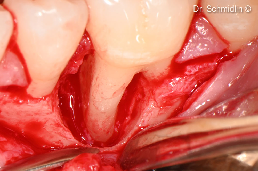 View of the defect after degranulation and cleaning