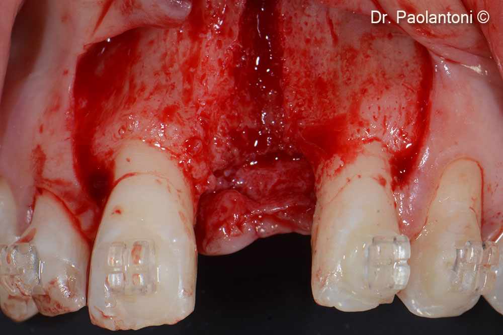 Vertical bone defect after flap elevation