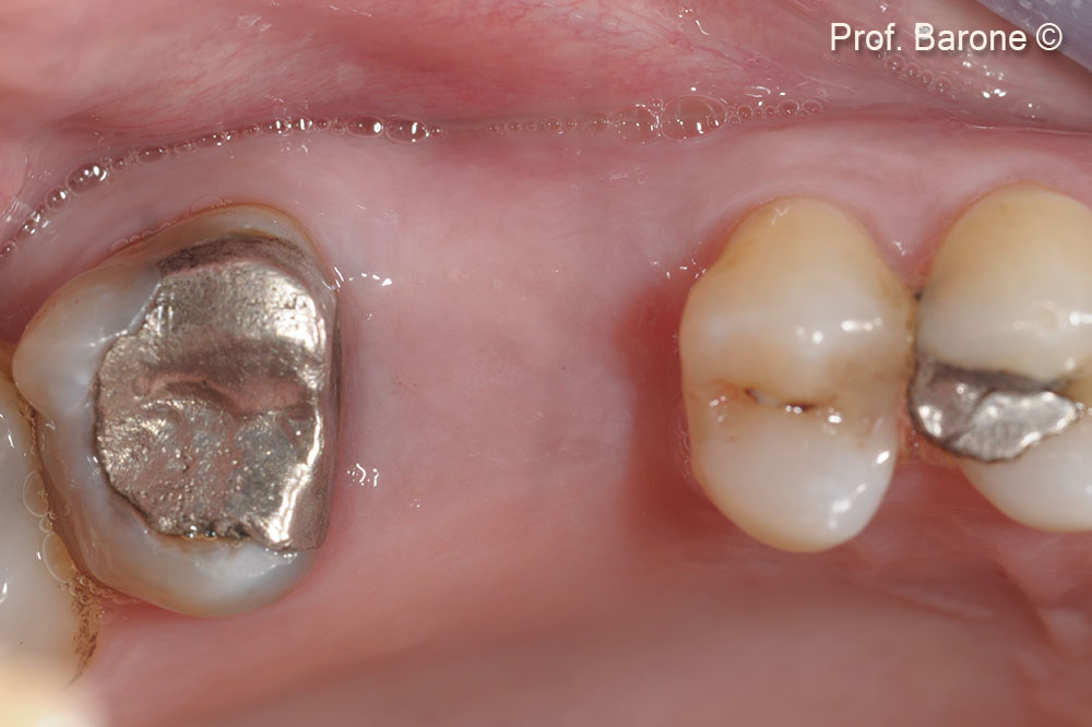 Healing after 4 months