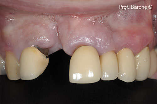 Healing after 3 months