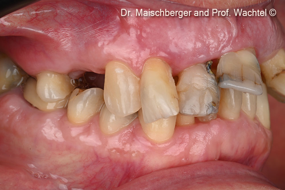 Intraoral right lateral view – initial situation.