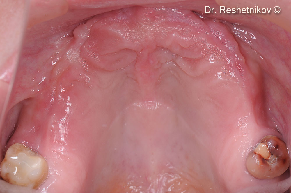 Intraoral view. Severe destruction of the alveolar ridge of the upper jaw and soft tissue deficiency