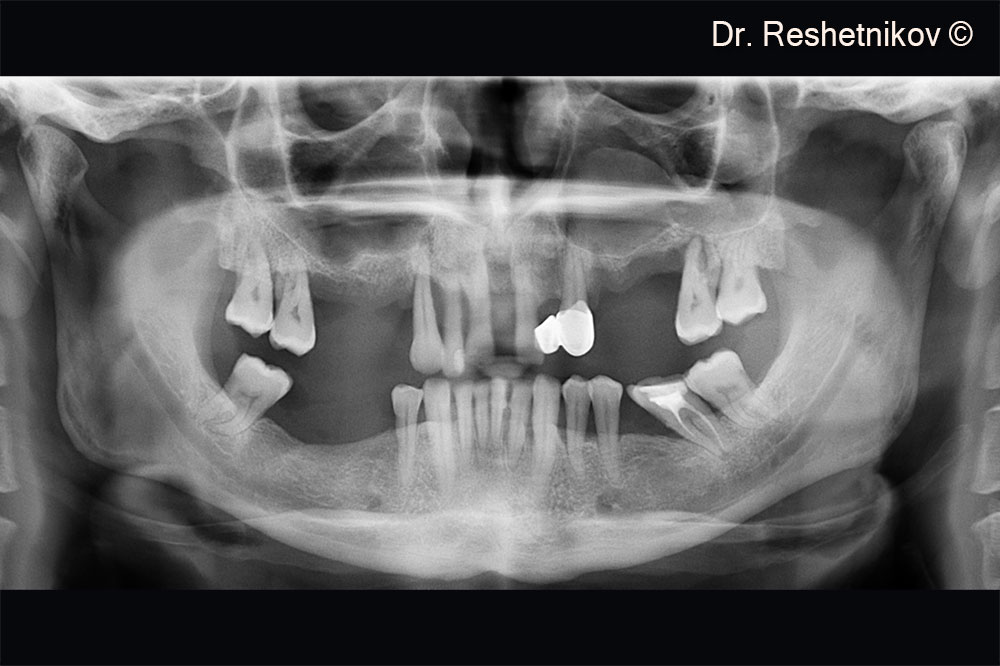 Panoramic radiograph. The upper anterior teeth lack the periodontal ligament and bone tissue along the entire length of the tooth roots