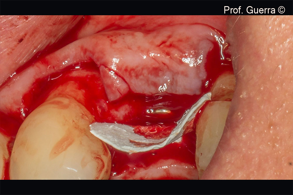 Membrane positioning in the palatal aspect