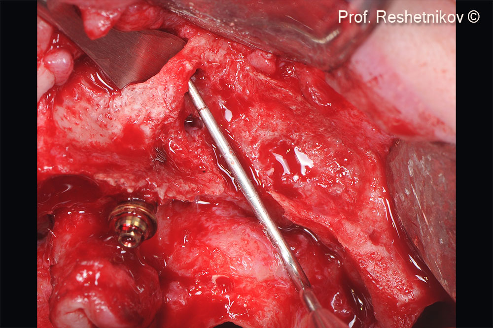 Probing and diagnostics revealed that implant fixation can only be possible with utilization of the cortical layer of the anterior wall in the maxillary sinus