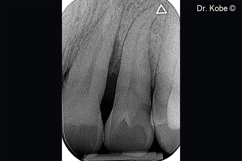 Vertical bone defect on the radiograph
