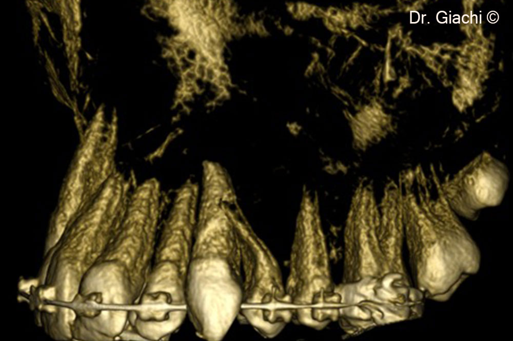CBCT rendering showing simulation of autotransplant position