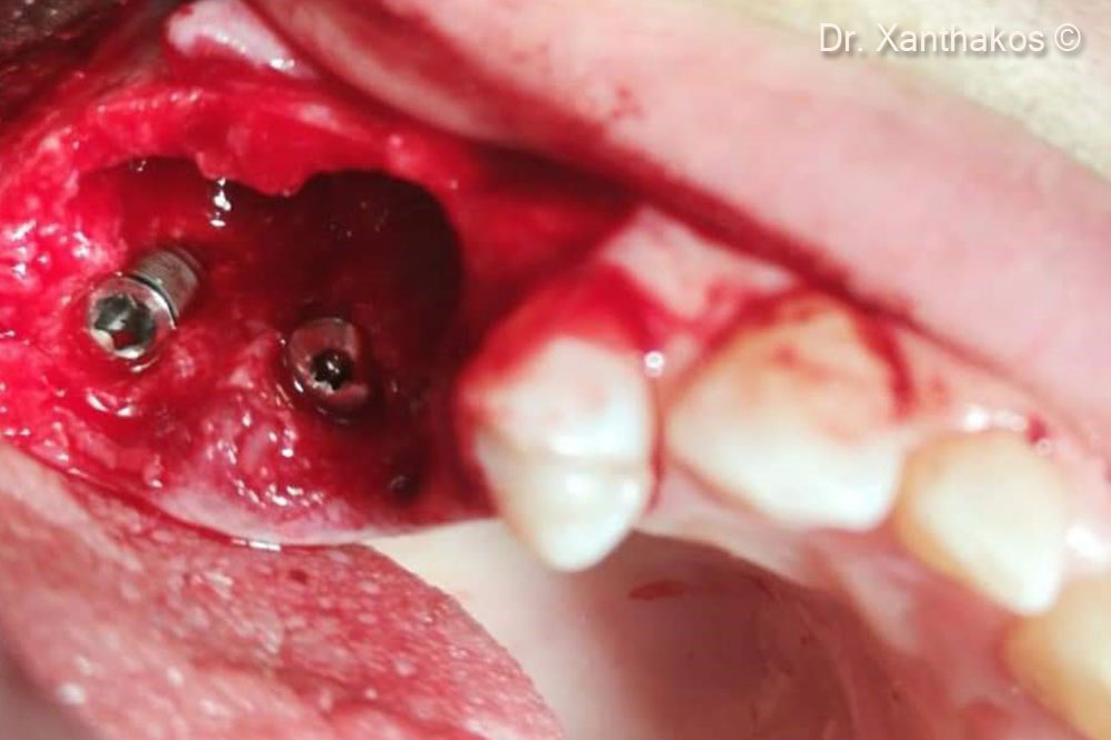 The surgical site was overfilled with mp3 without use of any extra barrier-membrane