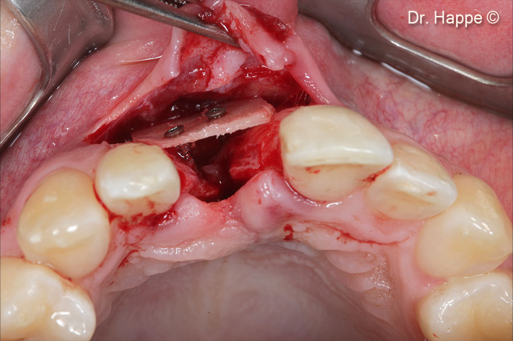 One part of Tecnoss Lamina was fixed buccaly with 1 osteosynthesis screw (1mm Diameter).