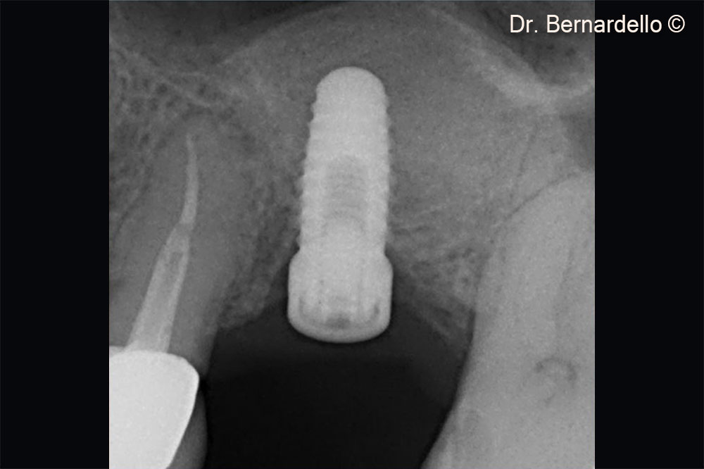 Immediate implant insertion