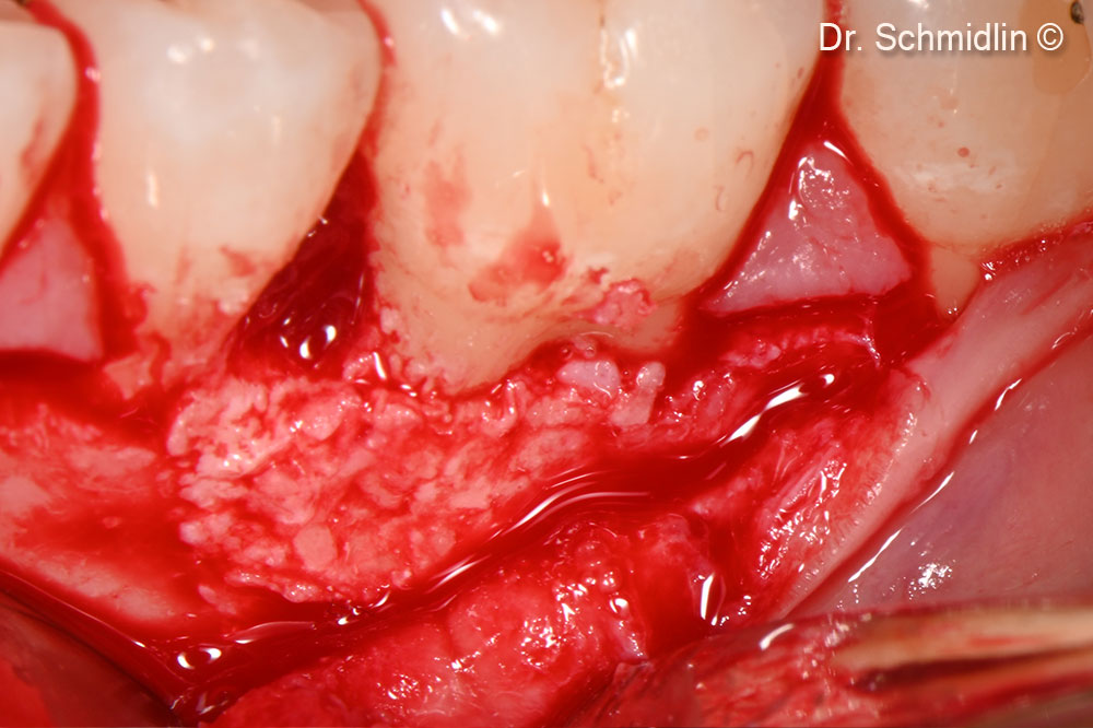 Application of the graft material GTO®