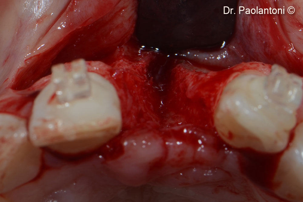 Horizontal bone defect after flap elevation