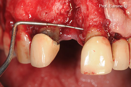 Residual Bone Defect, mesio-distal dimension