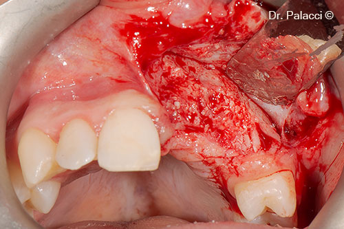 Newly formed bone at the re-entry time