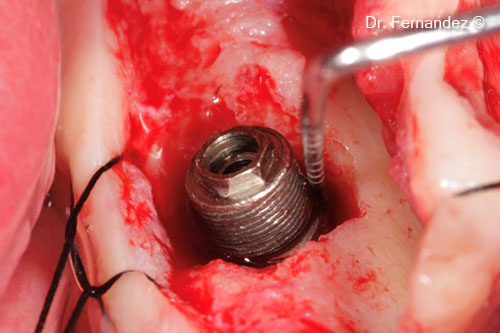 Cleaning and decontamination of the peri-implant defect and the implant surface