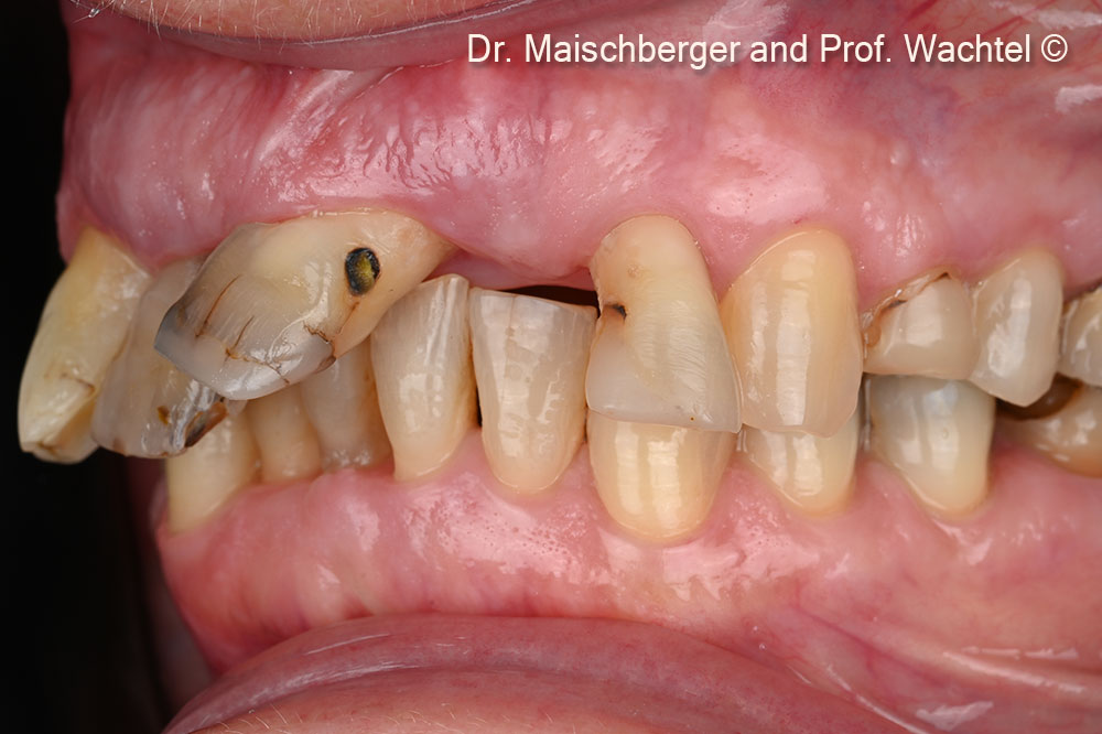 Intraoral left lateral view – initial situation.