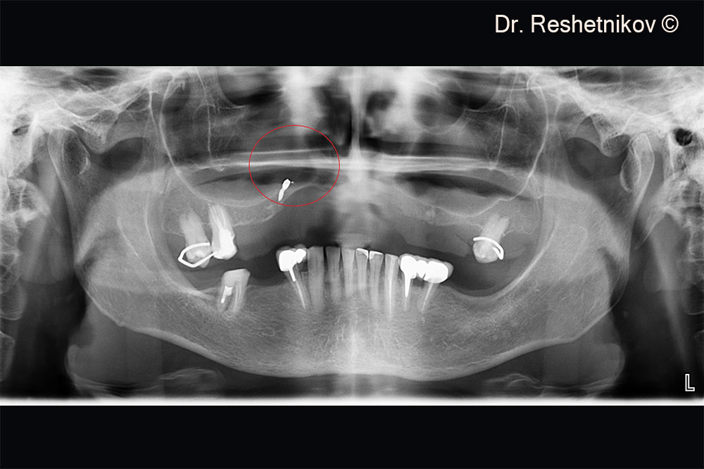 Panoramic radiograph of the bone tissue. In red circle: the area with the most pronounced atrophy of the alveolar ridge of the upper jaw