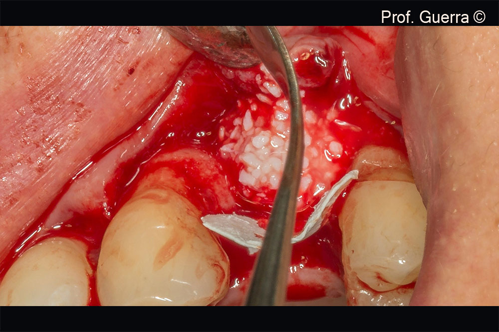 Gen-Os® particles placement