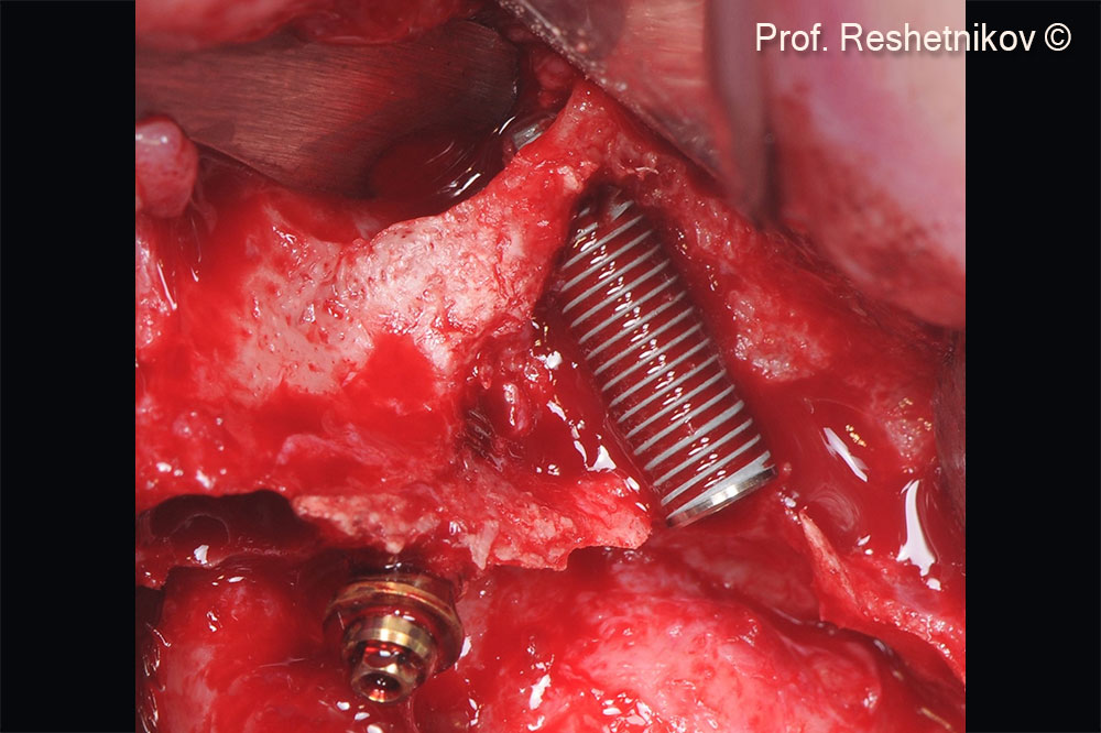 Implants installed according to the “All-on-4” protocol. The implant on site #25 installed at an angle with minimal torque (5 N/cm2). More than 4/5 of the implant is not covered with bone