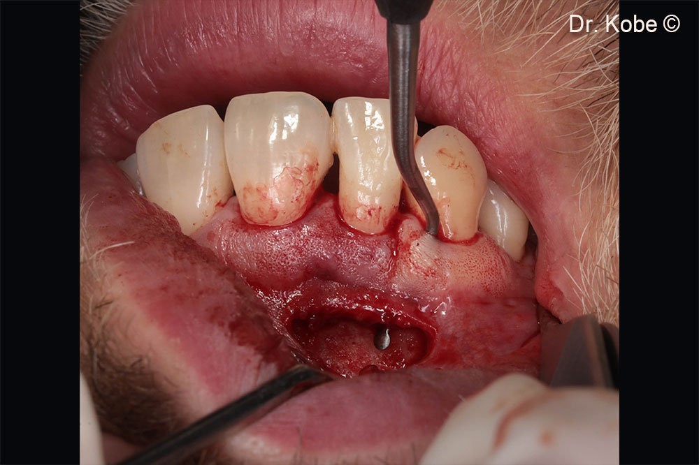 Horizontal incision (NIPSA) in the vestibule