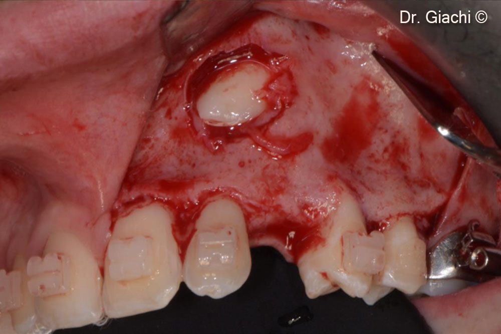 Atraumatic esposition of the canine