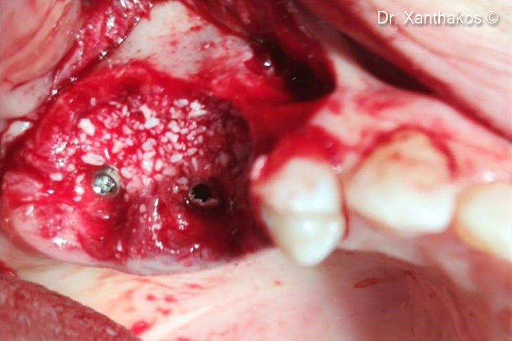 The surgical site was overfilled with mp3 without use of any extra barrier-membrane