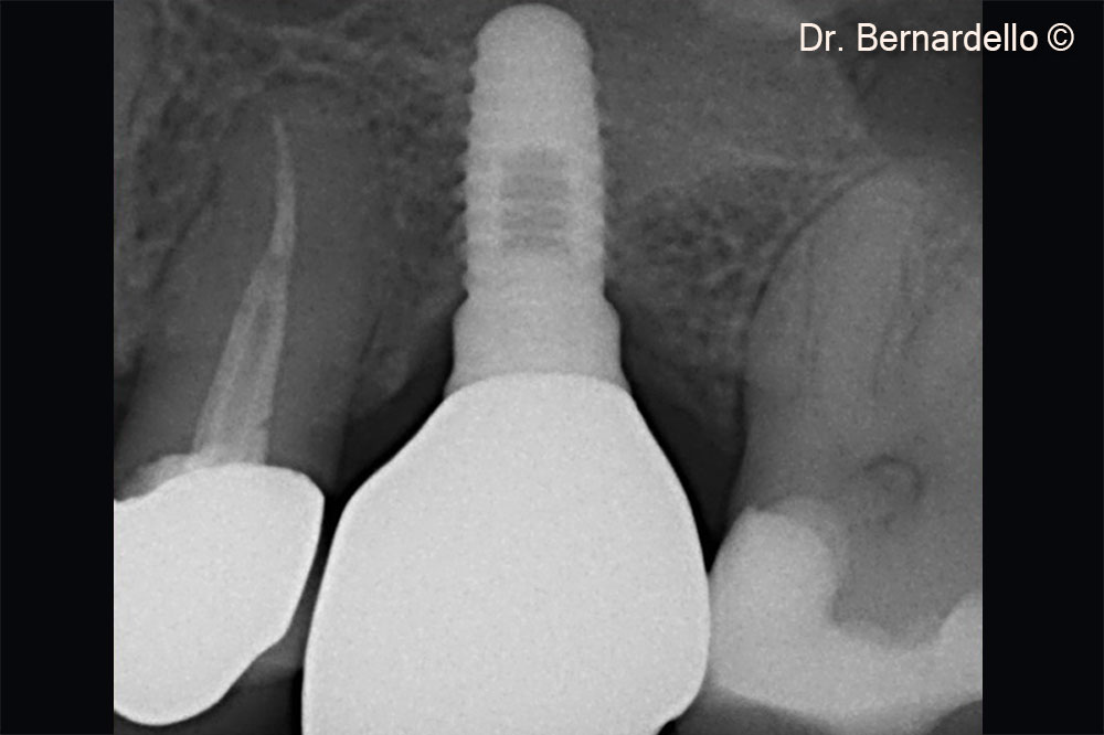 Immediate final restoration