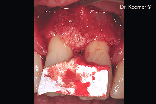 Defect filled with mp3® and tailored Evolution membrane