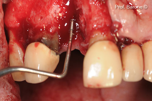 : Residual Bone Defect, vertical dimension