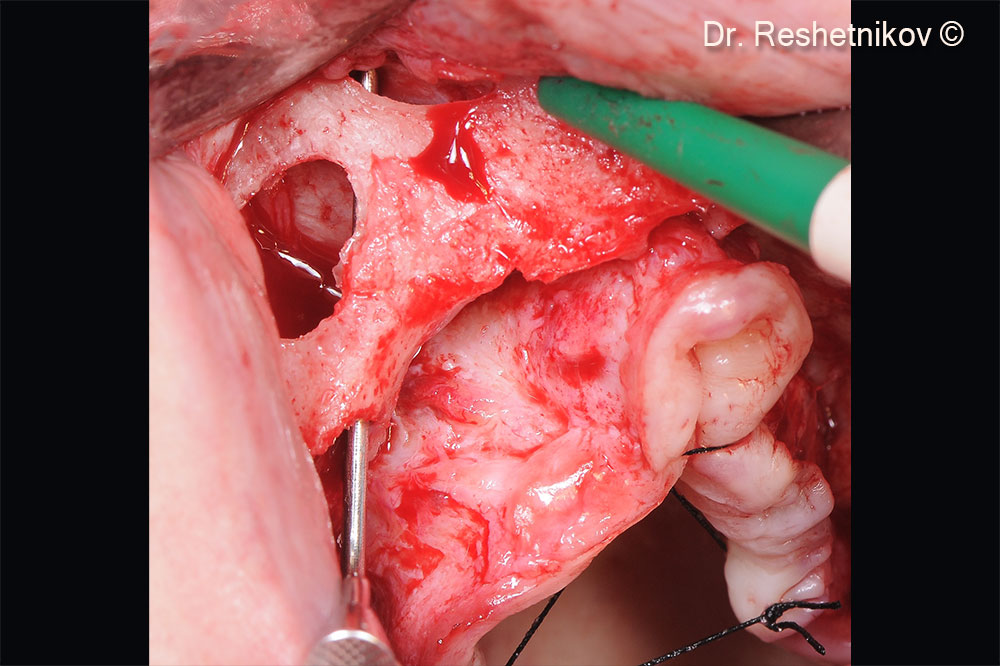 After infiltration anesthesia, teeth #16, #17 and #27 removed, a vestibular incision was made and the mucoperiosteal flap was skeletonized. Formation of access to the anterior and lateral walls of both maxillary sinuses with mobilization of the Schneiderian membrane