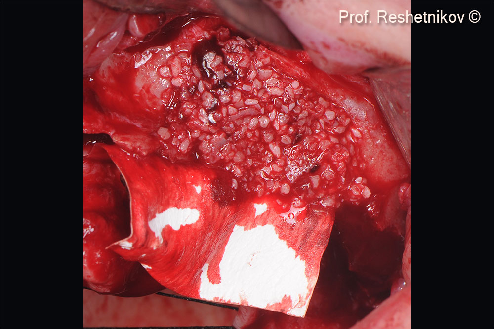 The defect filled with mp3® to restore the parameters of the alveolar ridge of the upper jaw