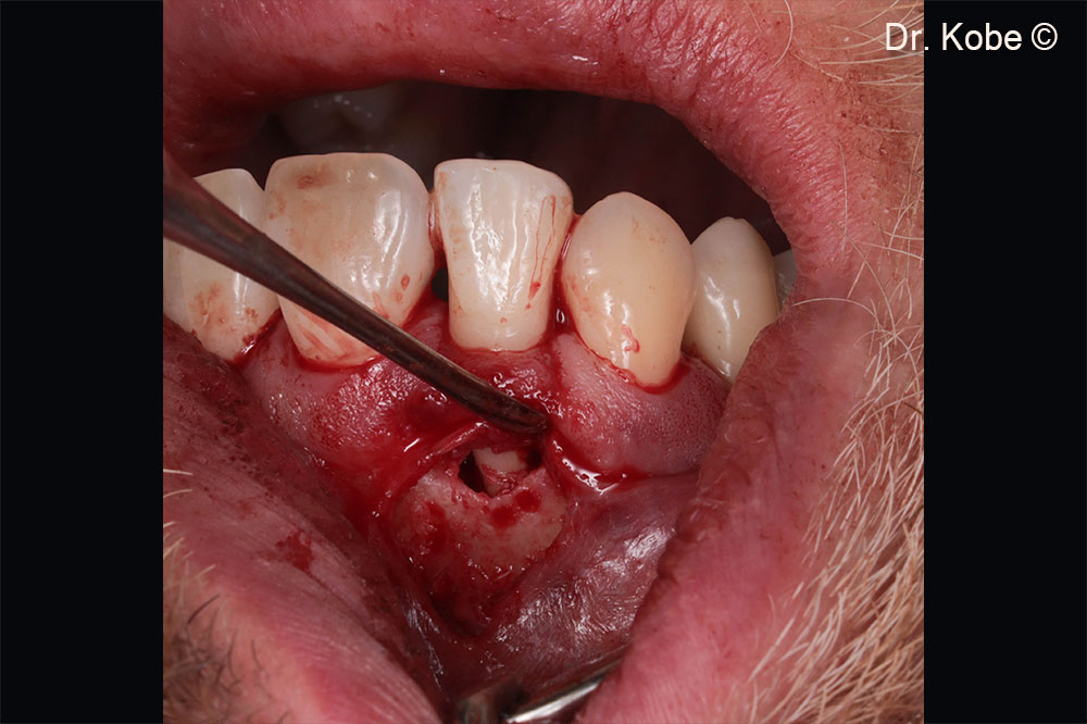 Access to the defect