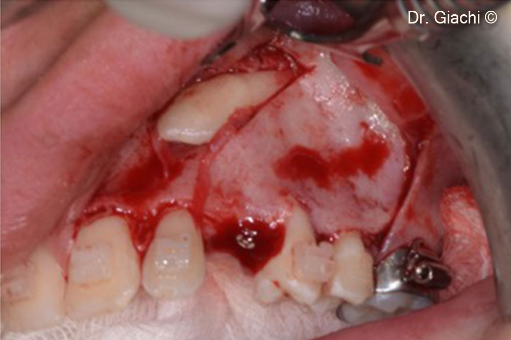 Complete surgical esposition in order to proceed with the extraction