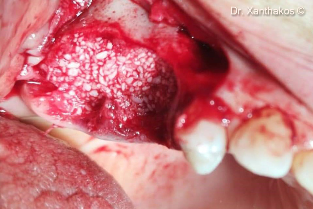 The surgical site was overfilled with mp3 without use of any extra barrier-membrane