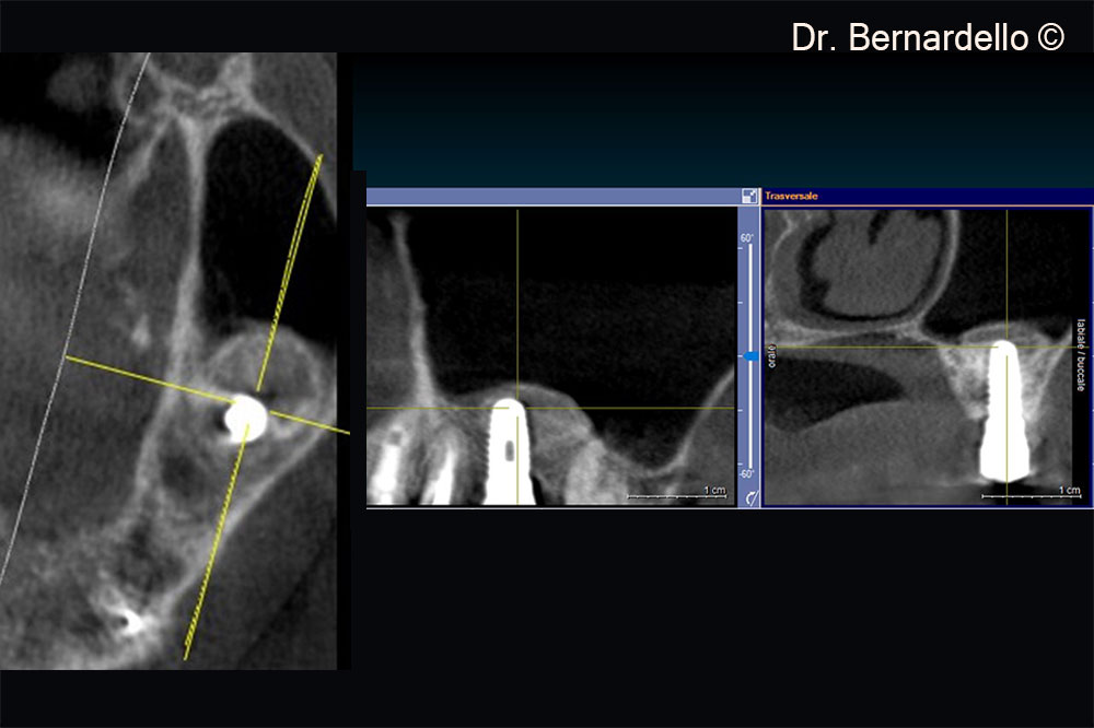 Above the apex on the implant, it is possible to see a thin layer of cortical bone
