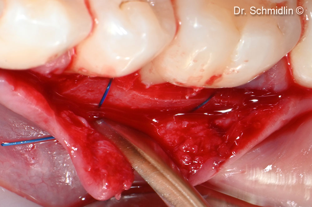 Deep horizontal matrace suture for cornal displacement of the flap and membrane stabilization