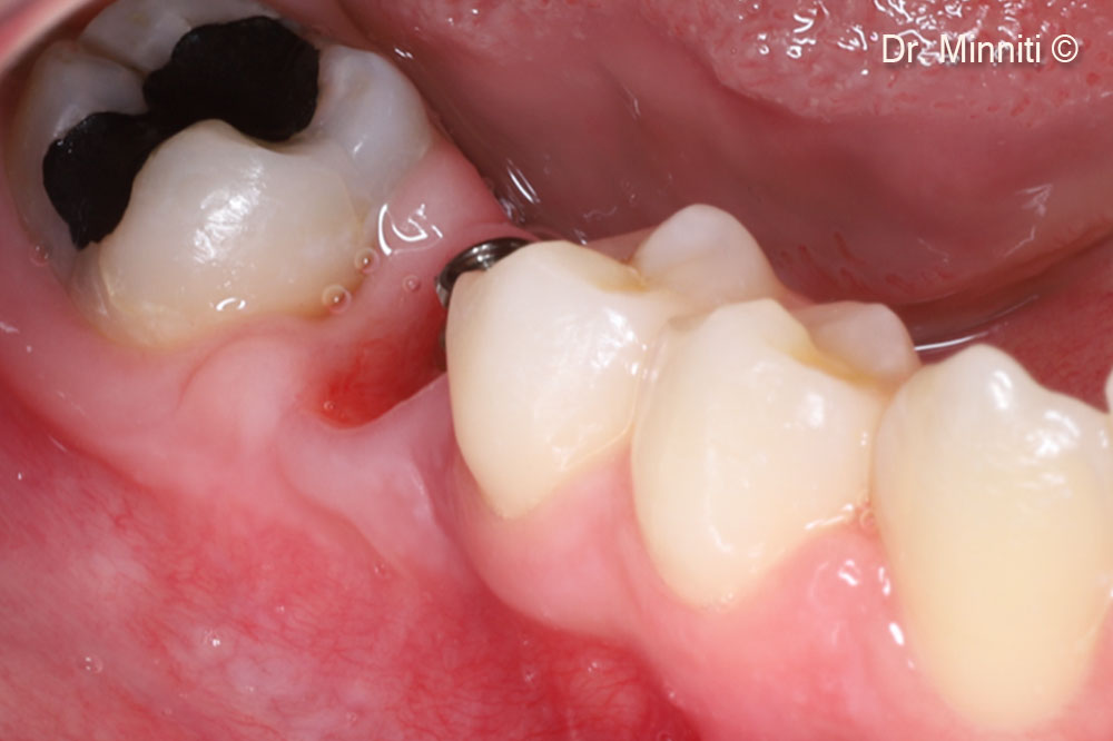 One-year follow-up - lateral view