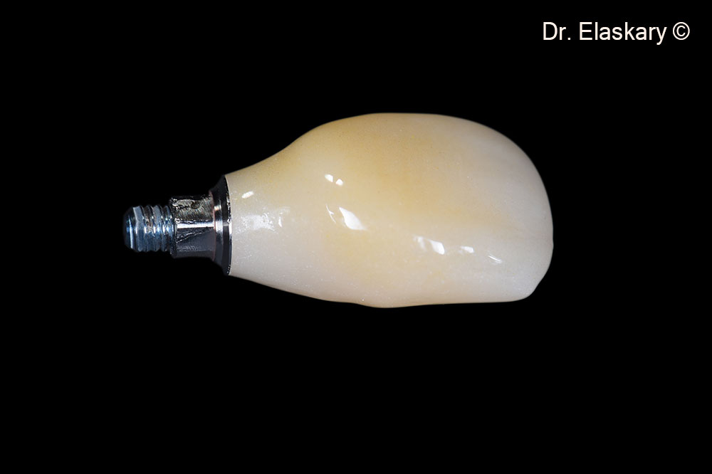 A screw retained zirconia crown is prepared